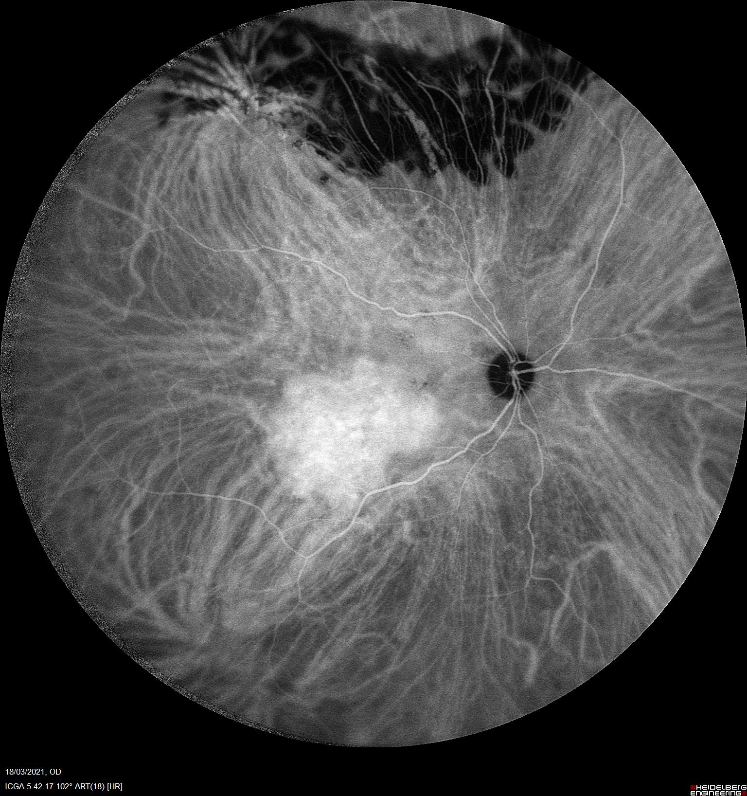 Hipercianescencia precoz en verde de indocianina en hemangioma coroideo