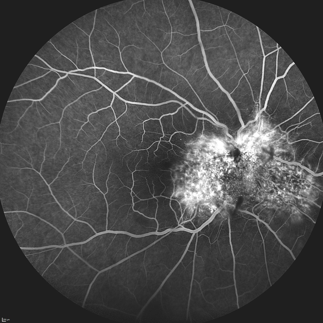 Angiografia fluoresceínica en hamartoma combinado de retina y epitelio pigmentario